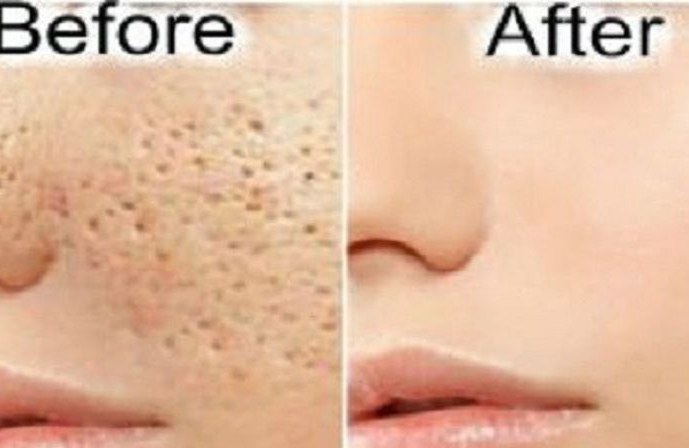 manfaat cuka apel mengecilkan pori-pori